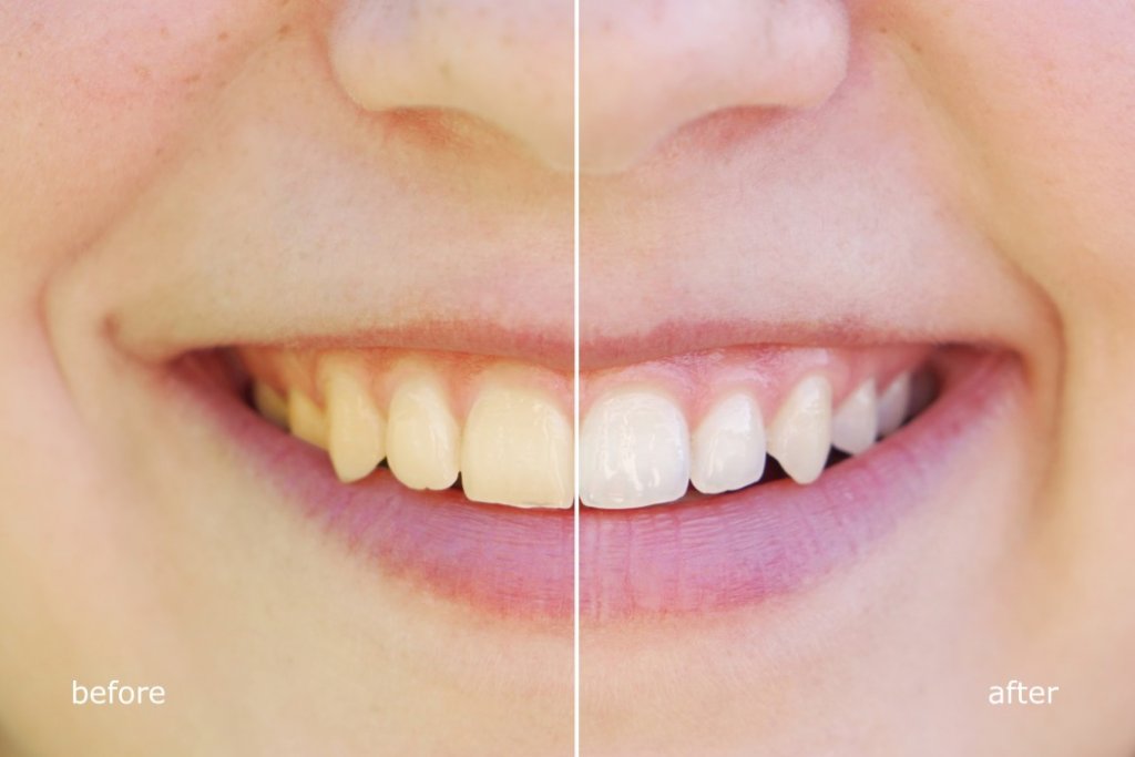 teeth whiting before and after